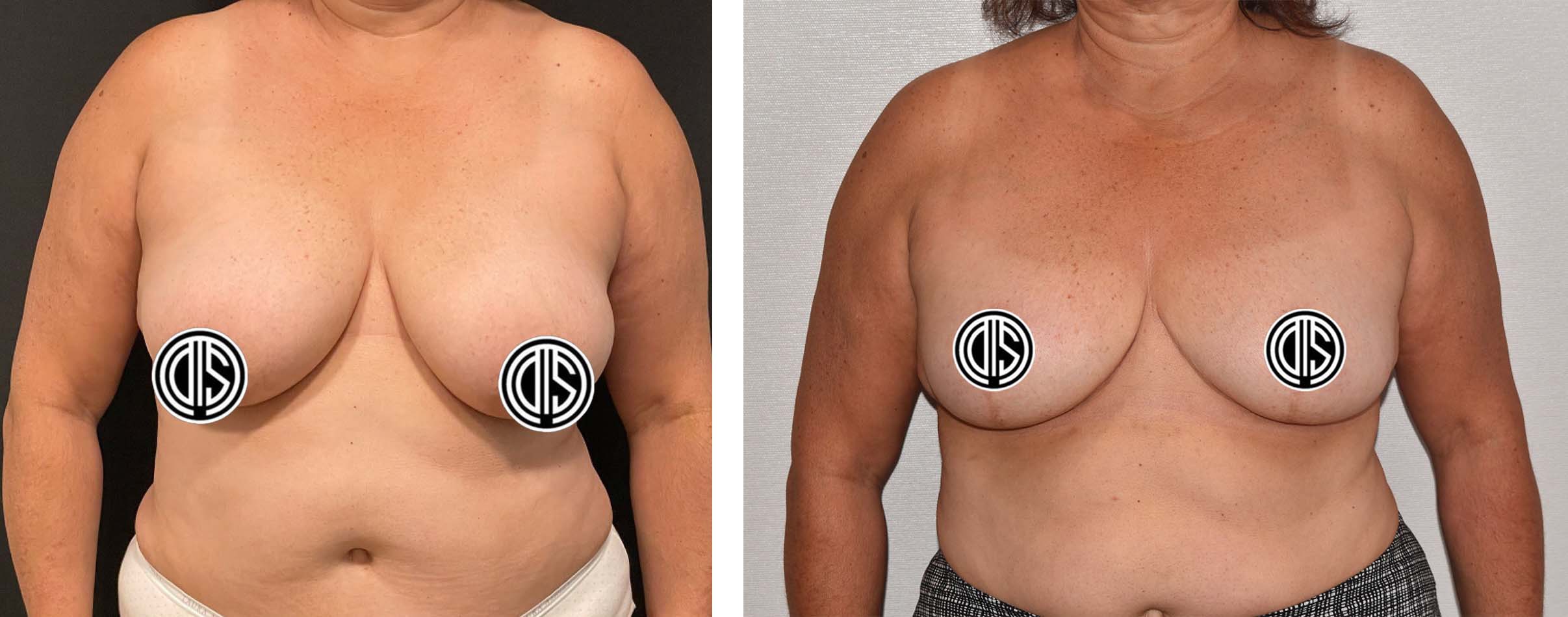 Breast reduction case 2, before surgery on the left and after surgery on the right
